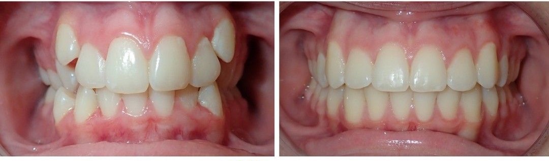 Malocclusion Correction